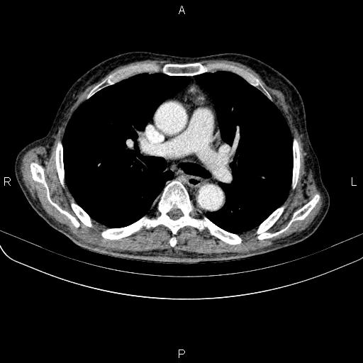 Ampullary adenocarcinoma (Radiopaedia 86093-102033 B 30).jpg