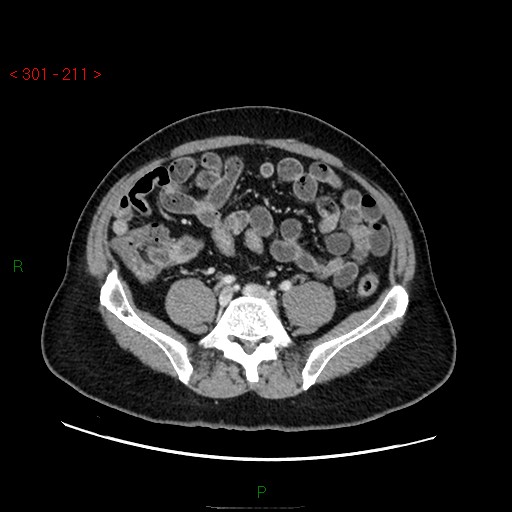 File:Ampullary carcinoma (Radiopaedia 56396-63056 C 68).jpg