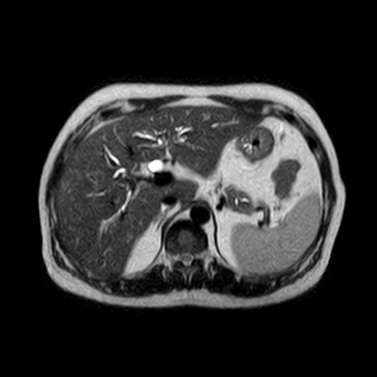 File:Ampullary tumor (Radiopaedia 27294-27479 T2 21).jpg