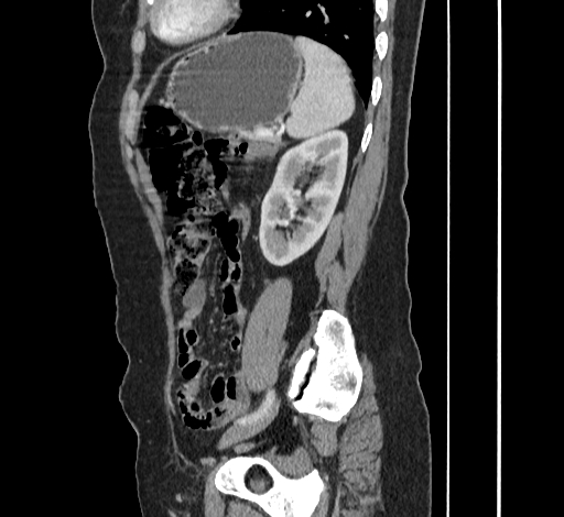 File:Ampullary tumor (Radiopaedia 60333-67998 C 45).jpg