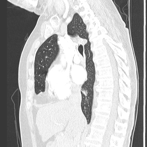 Amyloidosis - bronchial and diffuse nodular pulmonary involvement (Radiopaedia 60156-67745 Sagittal lung window 41).jpg