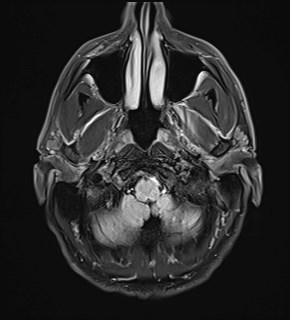 File:Amyotrophic lateral sclerosis (Radiopaedia 87352-103658 Axial FLAIR 2).jpg