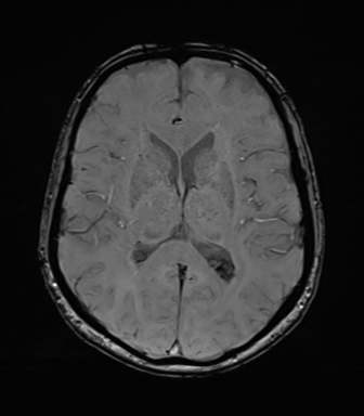 Anaplastic astrocytoma (Radiopaedia 86943-103160 Axial SWI 50).png