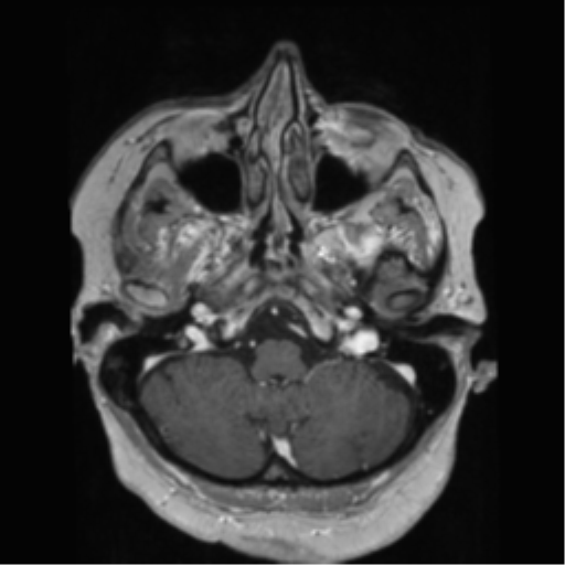 File:Anaplastic astrocytoma IDH wild-type (pseudoprogression) (Radiopaedia 42209-45278 Axial T1 C+ 38).png