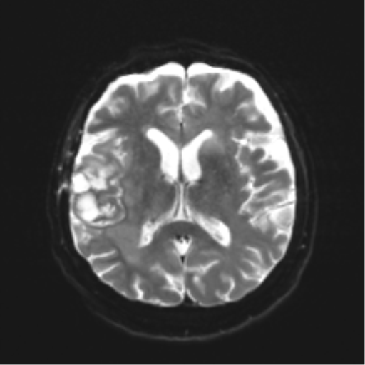 Anaplastic astrocytoma IDH wild-type (pseudoprogression) (Radiopaedia 42209-45279 Axial DWI 15).png