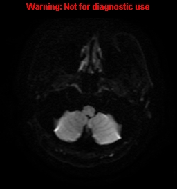 File:Anaplastic ganglioglioma (Radiopaedia 44921-48831 Axial DWI 2).jpg
