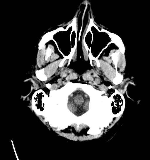 File:Anaplastic meningioma with recurrence (Radiopaedia 34452-35786 Axial non-contrast 4).png