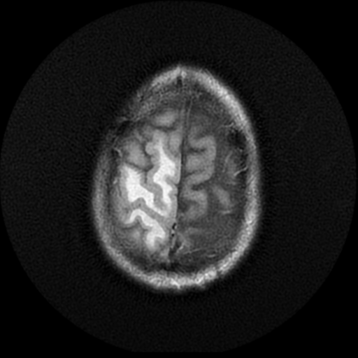 File:Anaplastic meningioma with recurrence (Radiopaedia 34452-35790 Axial T2 FLAIR 20).png