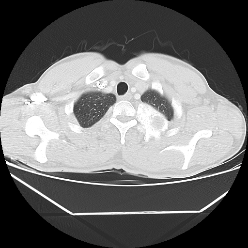 File:Aneurysmal bone cyst - rib (Radiopaedia 82167-96220 Axial lung window 15).jpg