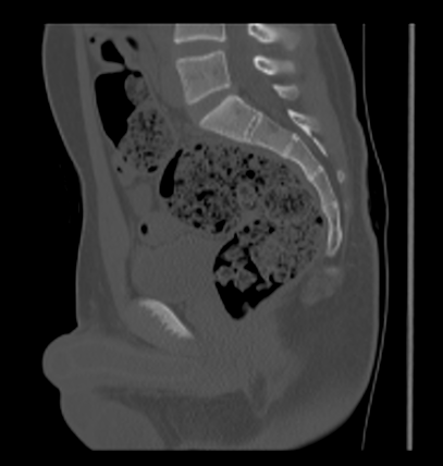 Aneurysmal bone cyst of ischium (Radiopaedia 25957-26094 Sagittal bone window 39).png
