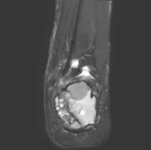 File:Aneurysmal bone cyst of the calcaneus (Radiopaedia 60669-68420 Coronal T2 fat sat 17).jpg