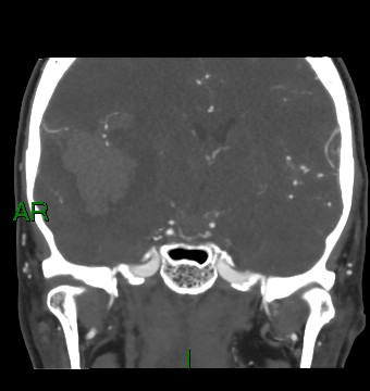 Aneurysmal subarachnoid hemorrhage with intra-axial extension (Radiopaedia 84371-99732 C 54).jpg