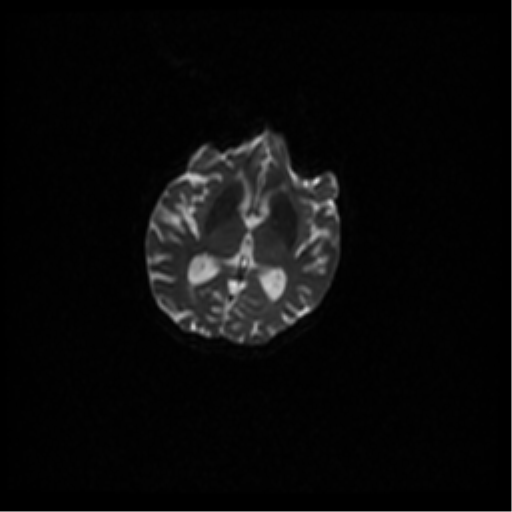 Angioinvasive aspergillosis in the pituitary fossa (Radiopaedia 39676-42010 Axial DWI 59).png