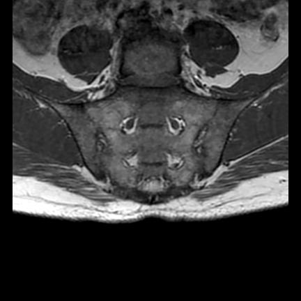 File:Ankylosing spondylitis with zygapophyseal arthritis (Radiopaedia 38433-40517 E 7).jpg