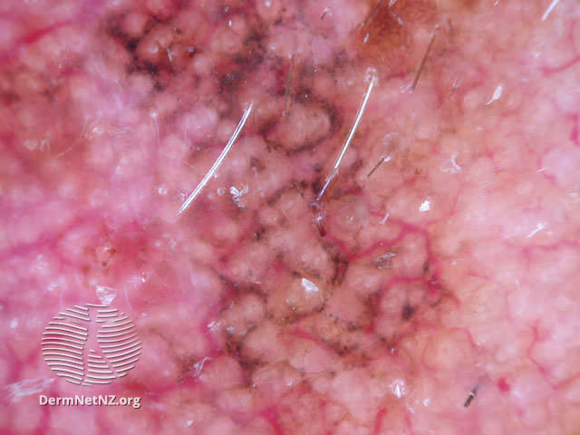 File:Annular granular pattern and rhomboids seen in dermoscopy of lentigo maligna (DermNet NZ doctors-dermoscopy-course-images-lm).jpg