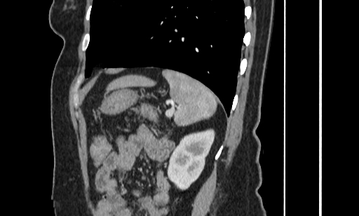 Annular pancreas (Radiopaedia 70359-80453 B 50).jpg