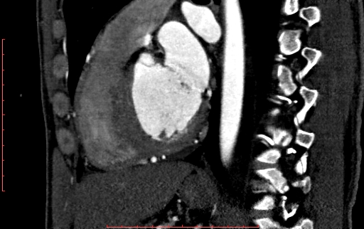 File:Anomalous left coronary artery from the pulmonary artery (ALCAPA) (Radiopaedia 70148-80181 C 146).jpg