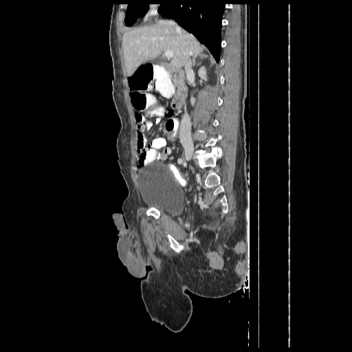Anorectal carcinoma (Radiopaedia 44413-48064 C 40).jpg