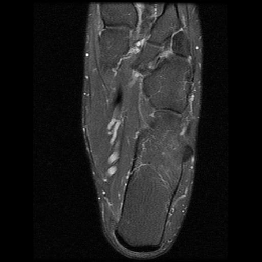 File:Anterior calcaneal process fracture (Radiopaedia 74654-85611 Axial PD fat sat 21).jpg