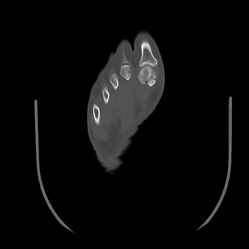 Anterior calcaneal process fracture (Radiopaedia 82590-96762 Axial bone window 41).jpg
