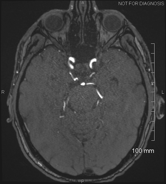Anterior cerebral artery aneurysm (Radiopaedia 80683-94127 Axial MRA 87).jpg