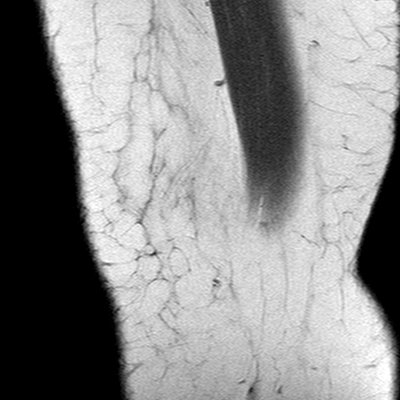 Anterior cruciate ligament mucoid degeneration (Radiopaedia 60853-68633 Sagittal T1 2).jpg