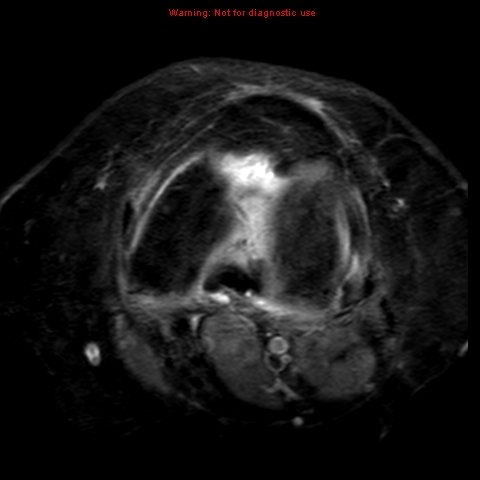 File:Anterior cruciate ligament tear (Radiopaedia 12329-12612 Axial T2 fat sat 10).jpg