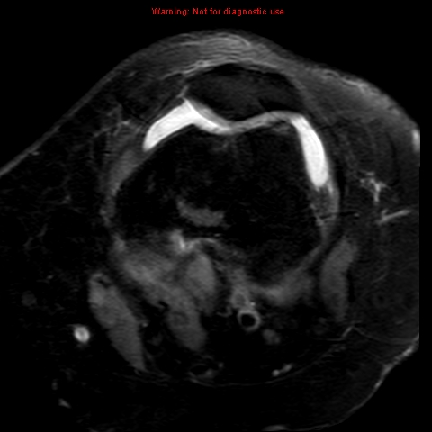File:Anterior cruciate ligament tear (Radiopaedia 12329-12612 Axial T2 fat sat 16).jpg