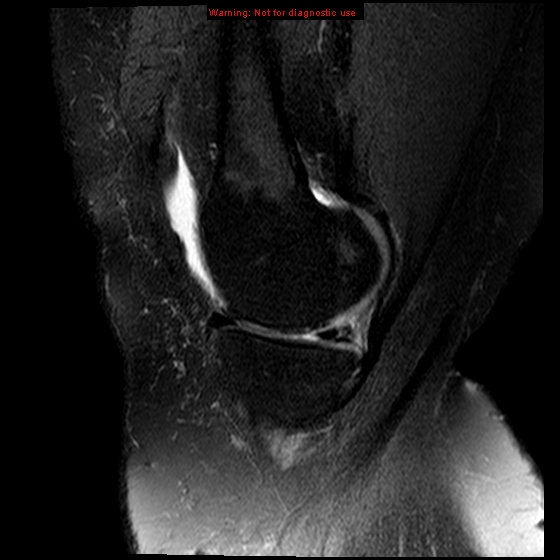 File:Anterior cruciate ligament tear (Radiopaedia 12329-12612 E 16).jpg