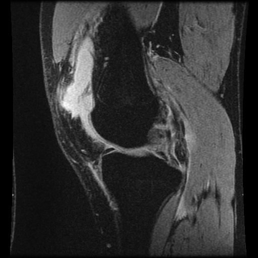 Anterior cruciate ligament tear (Radiopaedia 61500-69462 F 29).jpg