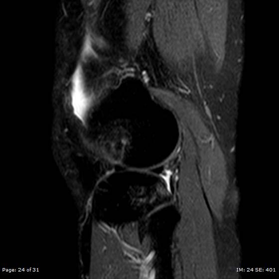 File:Anterior cruciate ligament tear (Radiopaedia 70783-80964 Sagittal STIR 24).jpg