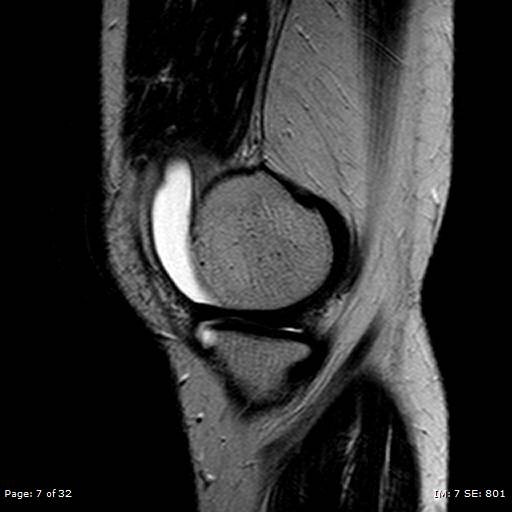 File:Anterior cruciate ligament tear (Radiopaedia 70783-80964 Sagittal T2 7).jpg