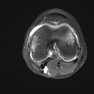 File:Anterior cruciate ligament tear - pediatric (Radiopaedia 62152-70260 Axial PD fat sat 20).jpg