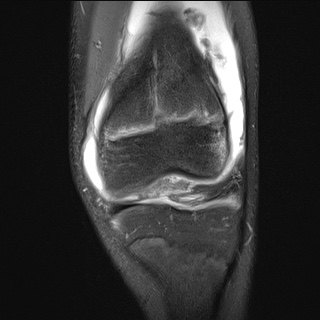 File:Anterior cruciate ligament tear - pediatric (Radiopaedia 62152-70260 Coronal PD fat sat 19).jpg