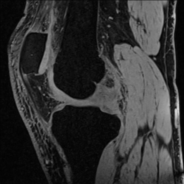 Anterior cruciate ligament tear - ramp lesion (Radiopaedia 71883-82322 Sagittal T1 vibe 83).jpg