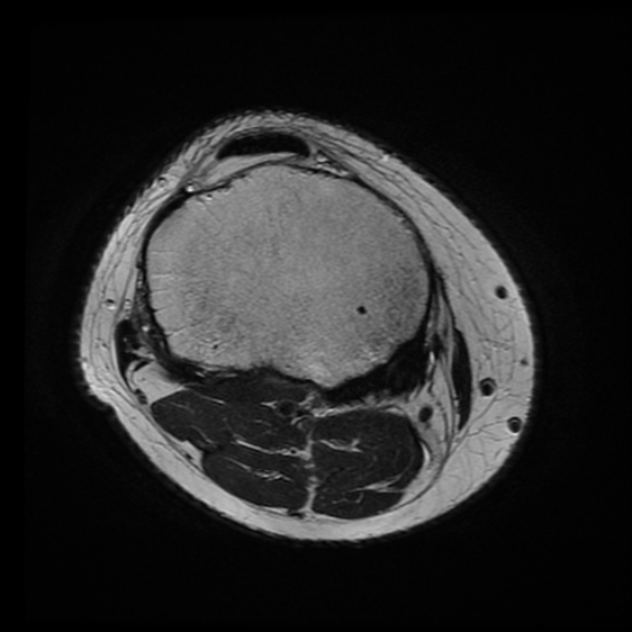 File:Anterior cruciate ligament tear with posteromedial corner injury, bucket-handle meniscal tear and chondral delamination (Radiopaedia 75501-86744 Axial T2 4).jpg