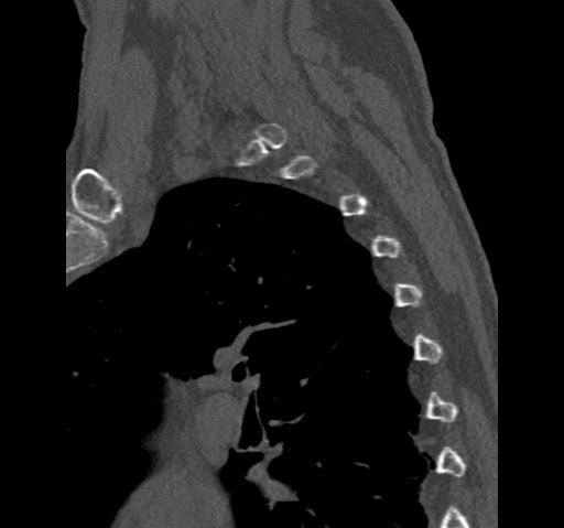 Anterior glenohumeral dislocation with Hill-Sachs lesion (Radiopaedia 62877-71249 Sagittal bone window 71).jpg