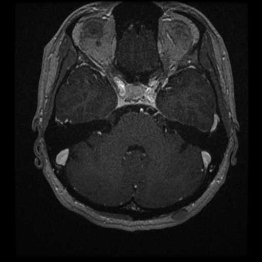 Anterior inferior cerebellar artery vascular loop - type II (Radiopaedia 70991-81209 Axial T1 C+ 31).jpg
