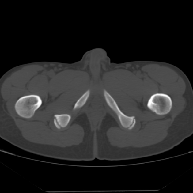 Anterior inferior iliac spine avulsion fracture (Radiopaedia 49469-54627 Axial bone window 57).jpg