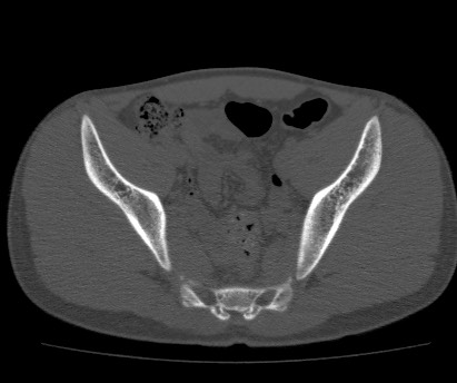 Anterior inferior iliac spine avulsion fracture (Radiopaedia 81312-94999 Axial bone window 38).jpg