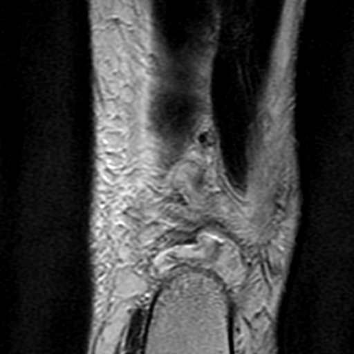 File:Anterior talofibular ligament rupture (Radiopaedia 15831-15484 Coronal T2 20).jpg