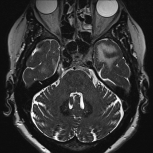 Anterior temporal pole cysts (Radiopaedia 46629-51102 Axial 16).png