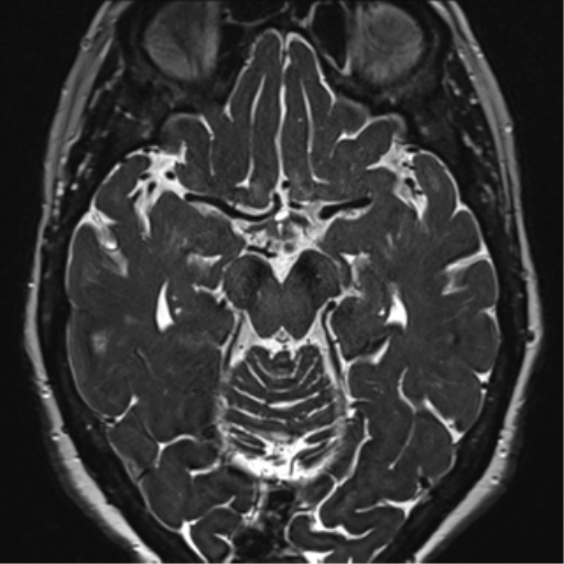Anterior temporal pole cysts (Radiopaedia 46629-51102 Axial 51).png
