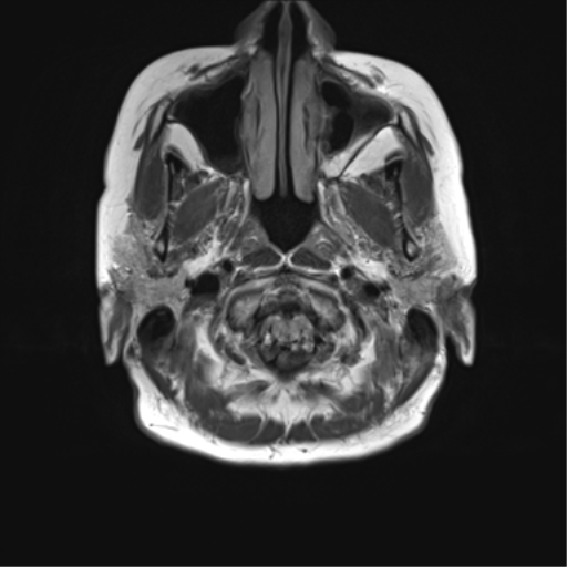 File:Anterior temporal pole cysts (Radiopaedia 46629-51102 Axial FLAIR 1).png