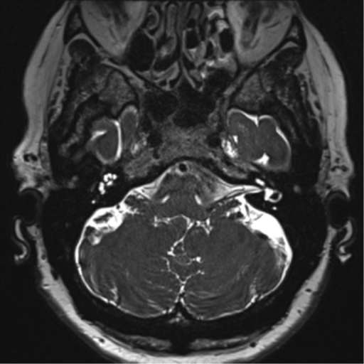 Anterior temporal pole cysts (Radiopaedia 46629-51102 Axial T2 28).png
