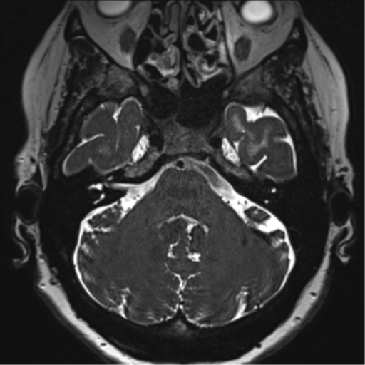 File:Anterior temporal pole cysts (Radiopaedia 46629-51102 Axial T2 34).png