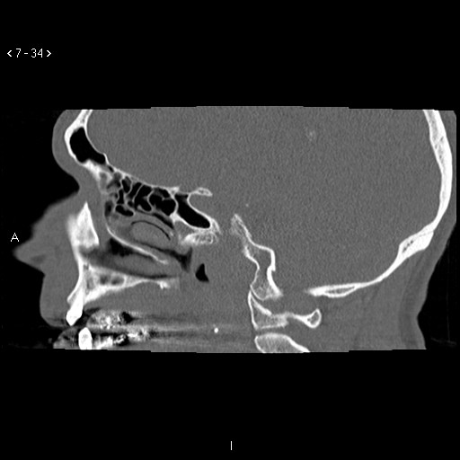File:Antrochoanal Polyp (Radiopaedia 70510-80631 Sagittal bone window 24).jpg