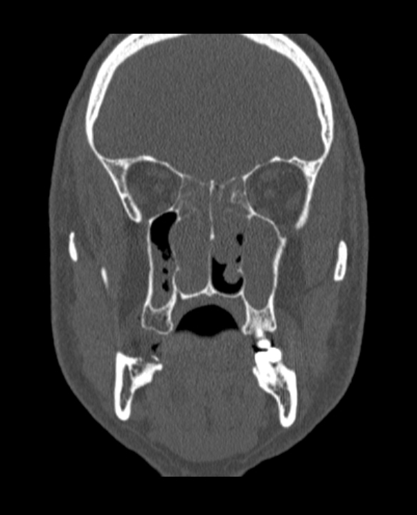 Antrochoanal polyp (Radiopaedia 79011-92169 Coronal bone window 41).jpg