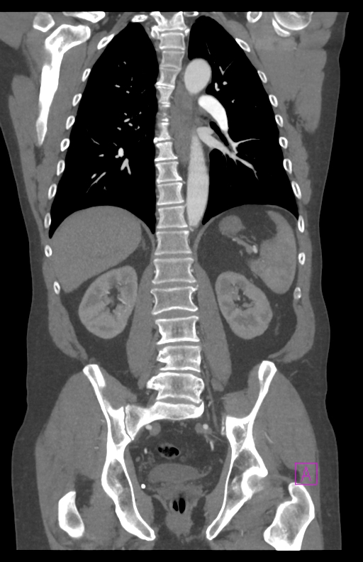 Aortectomy and axillary-bifemoral bypass (Radiopaedia 28303-28545 C 60).jpg
