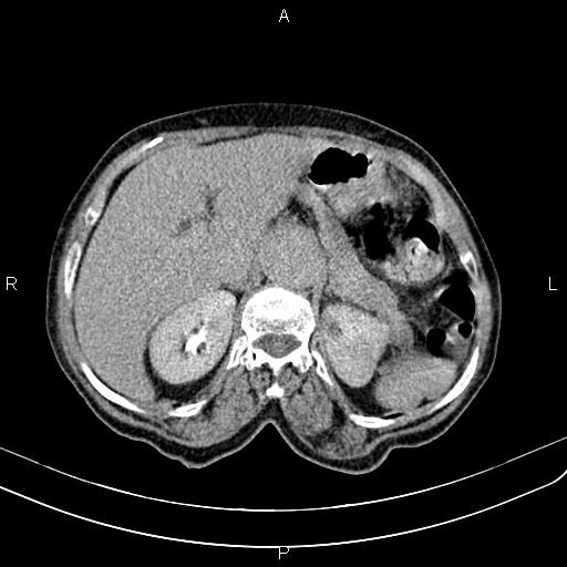 Aortic aneurysm and Lemmel syndrome (Radiopaedia 86499-102554 Axial C+ delayed 23).jpg